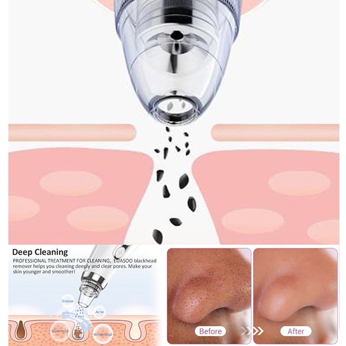 Visual Blackhead Removal B12